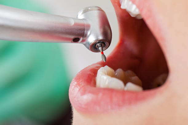 Best Emergency Dental Extractions in Sugar Land, TX